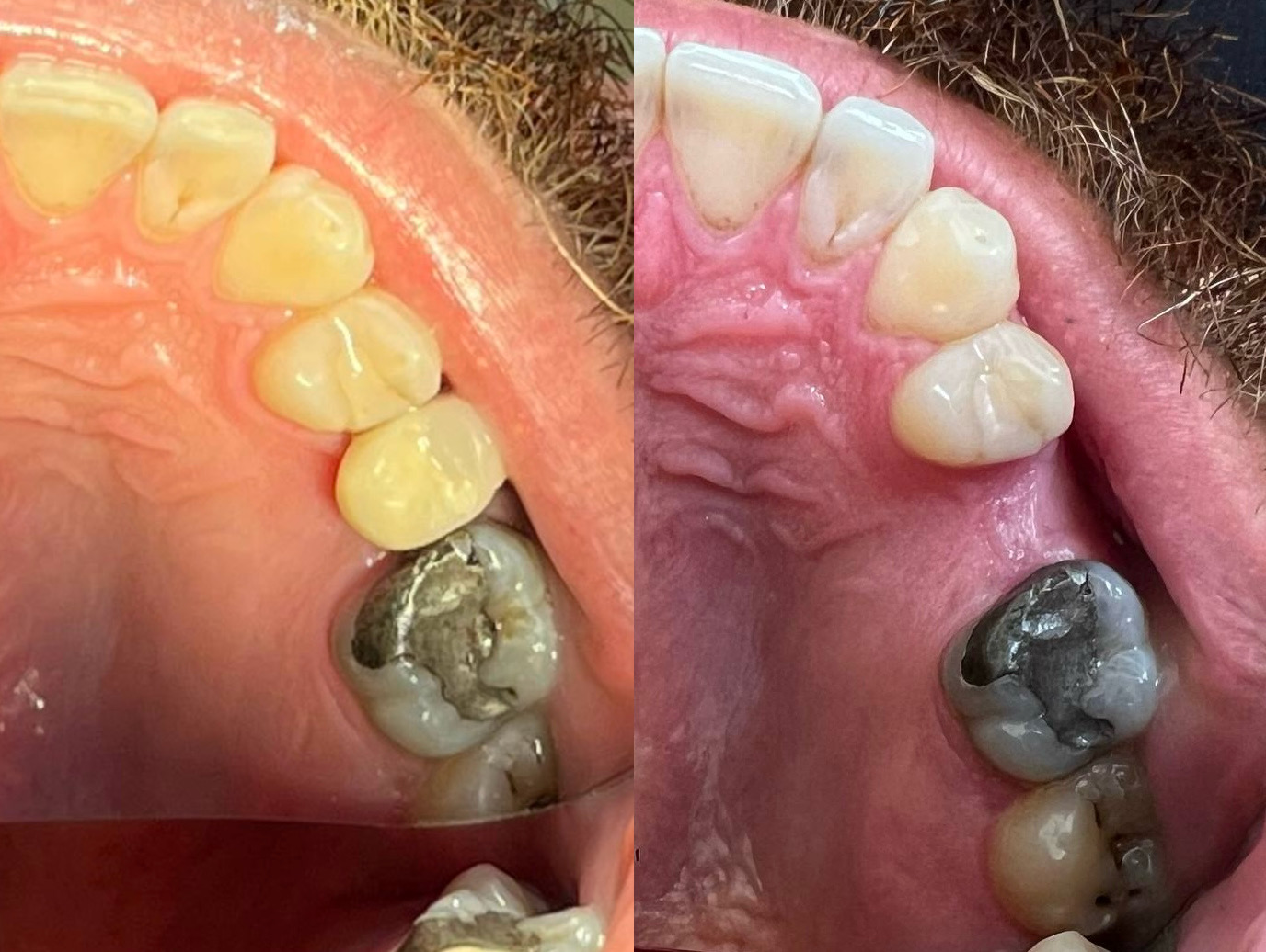 نمونه درمان ایمپلنت و تحویل روکش پیچ شونده در Drgravand